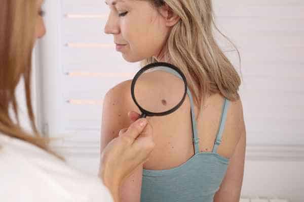 What Are Traditional Skin Lesion Removal Methods Thame?