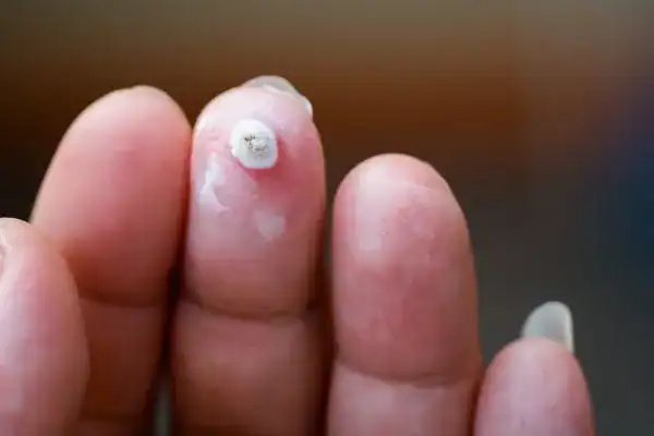 Image of white wart before cryopen treatment Thame