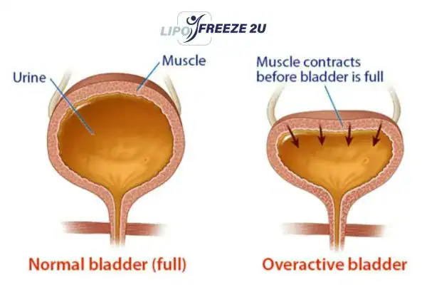 diagram of overactive bladder treatment Thame