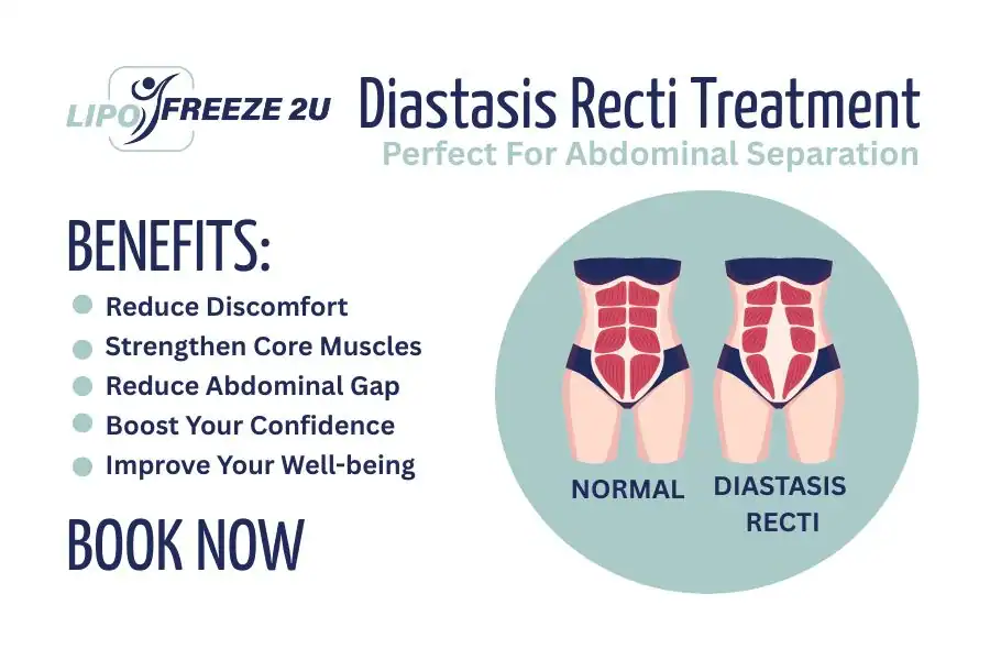 Benefits of body toning treatment Thame for Diastasis recti