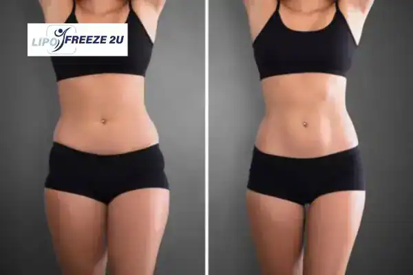 How Can LIPO FREEZE 2U Support Your Post-Pregnancy Body Recovery Thame?