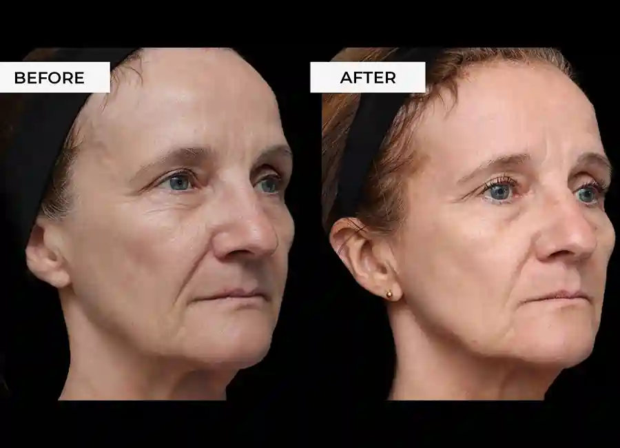 How Many RF Microneedling Sessions Will You Need to See a Difference Thame?