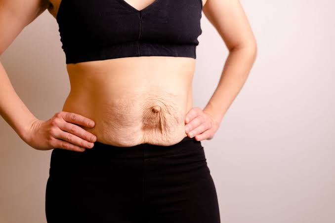 Is Surgery Really the Only Way to Repair Diastasis Recti Thame?