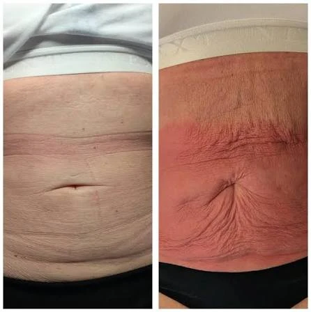 How Does RF Microneedling Improve Crepey, Thin and Uneven Skin Texture Thame?
