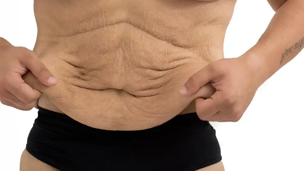 RF Microneedling for Loose Skin: How Can It Help Tighten and Reshape the Skin Thame?